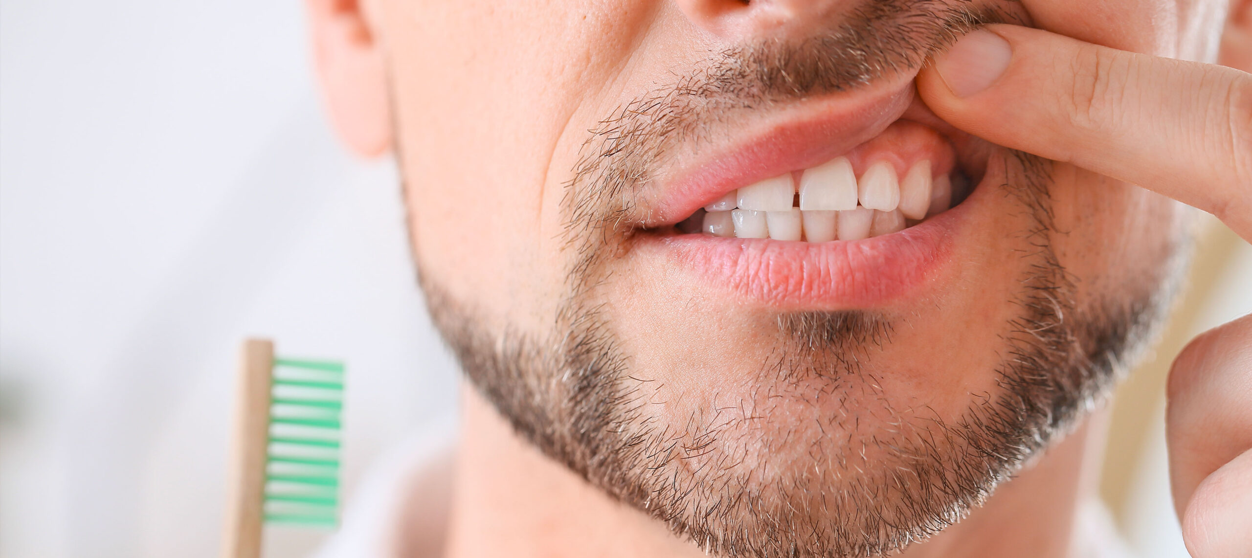 Gros plan de la bouche d'un homme barbu présentant une gencive irritée, illustrant la nécessité d'une greffe de gencive sur le site de la clinique dentaire Deslauriers Pissardo Jacques.