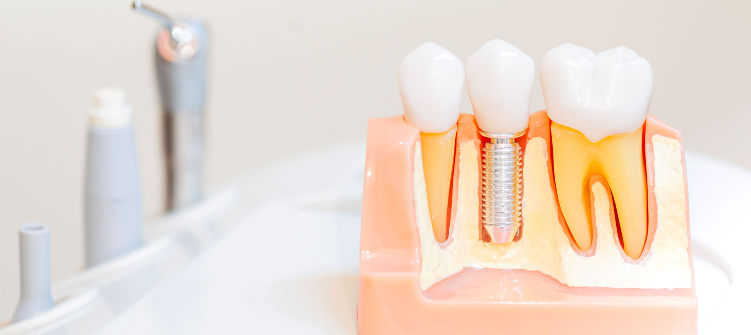 Maquette détaillée de la structure dentaire avec un implant intégré, clinique dentaire Deslauriers Pissardo Jacques, instruments dentaires flous en arrière-plan.