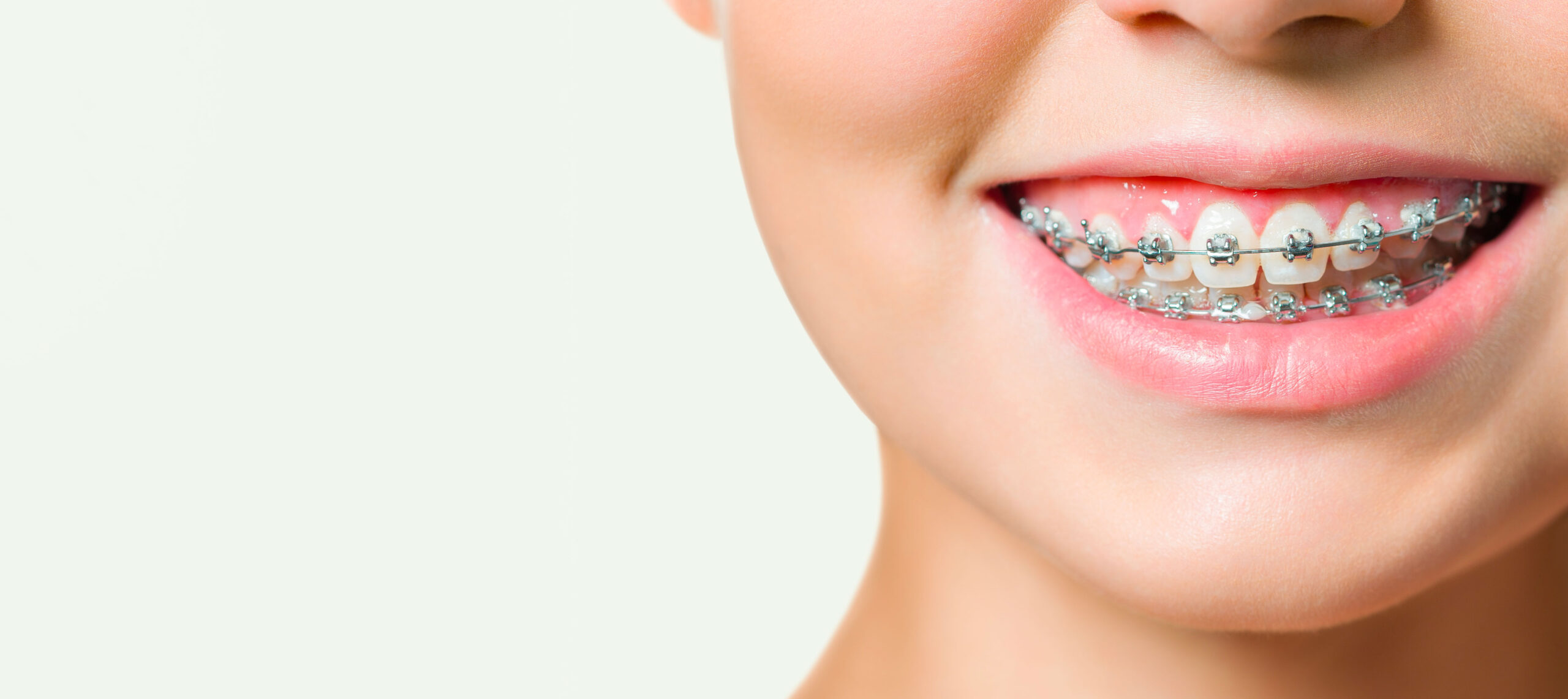 Clinique dentaire Deslauriers Pissardo Jacques : Gros plan d'une femme souriante arborant un appareil dentaire brillant.